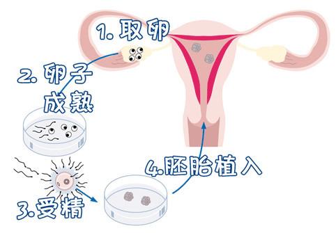 反覆流產
